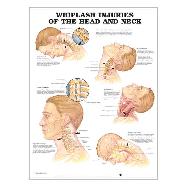 Chart "Whiplash injuries of the head and neck"