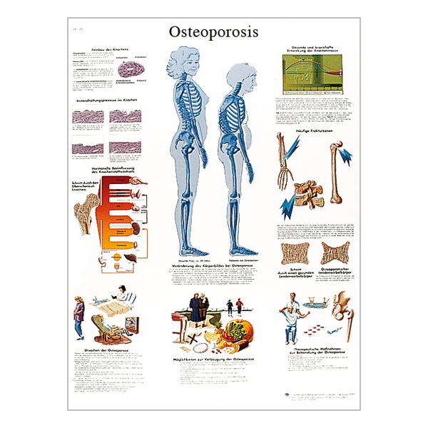 Charte « Osteoporosis »