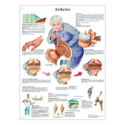 Charte « Arthritis »