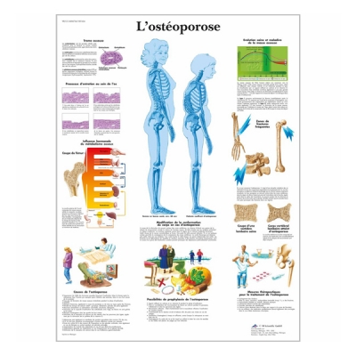 Chart "L'ostéoporose"
