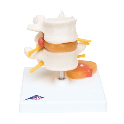 Lumbar Spinal Column with Prolapsed Intervertebral Disc